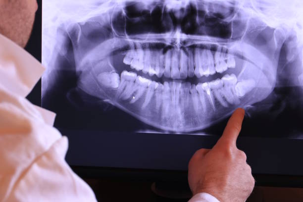 Best Emergency Treatment for Dental Infections or Abscesses in Fillmore, CA
