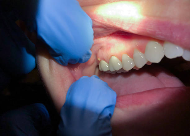 Best Emergency Gum Treatment in Fillmore, CA