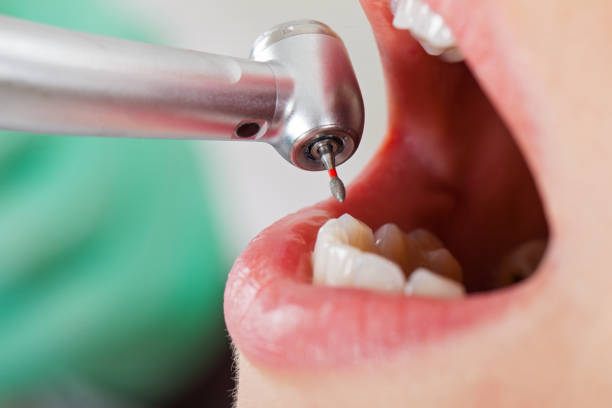 Best Urgent Care for Lost Fillings or Crowns in Fillmore, CA